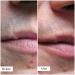 A man's lip scar before and after treatment A man's lip scar before and after treatment