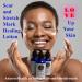 Woman applying Scar and Stretch Mark Healing Lotion to her face