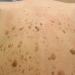 Serum: Seborrheic Keratoses Relief