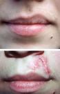 Cream or Serum, Scars, Scabies & Other Problems, Custom lip