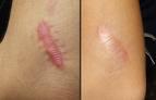 Cream or Serum, Scars, Scabies & Other Problems, Custom scar