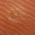 Wart-Balm_Anarres